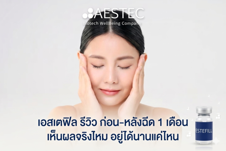 เอสเตฟิล รีวิว ก่อน หลังฉีด 1 เดือน