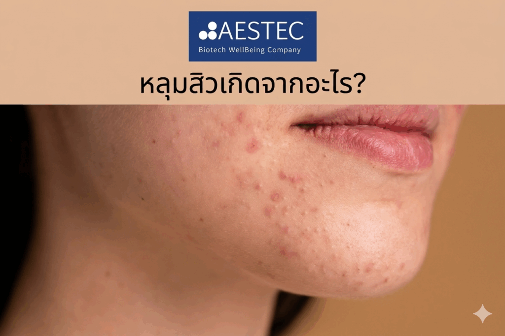 หลุมสิวเกิดจากอะไร